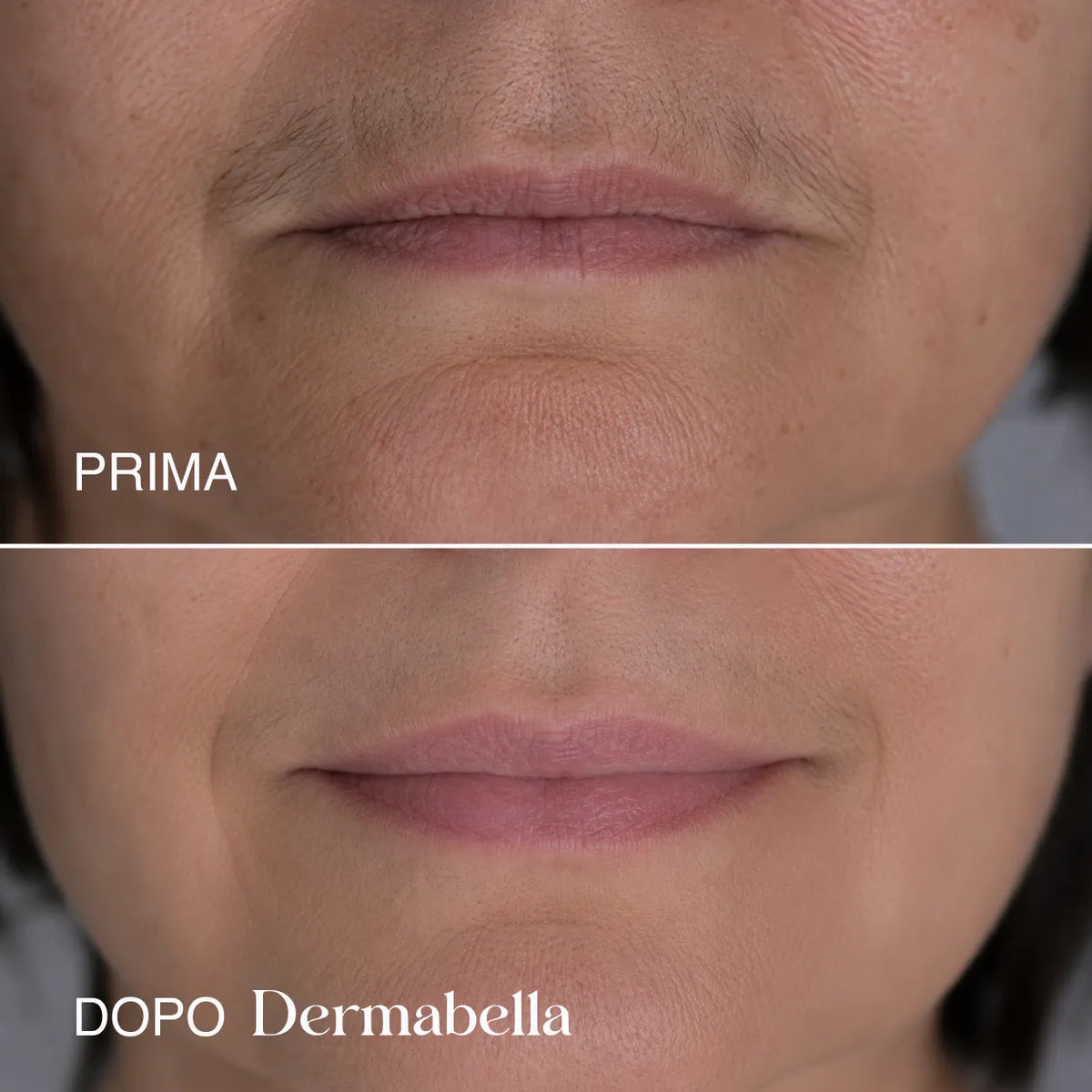 Risultato prima e dopo sul contorno labbra con Dermabella