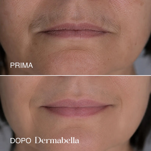Risultato prima e dopo sul contorno labbra con Dermabella