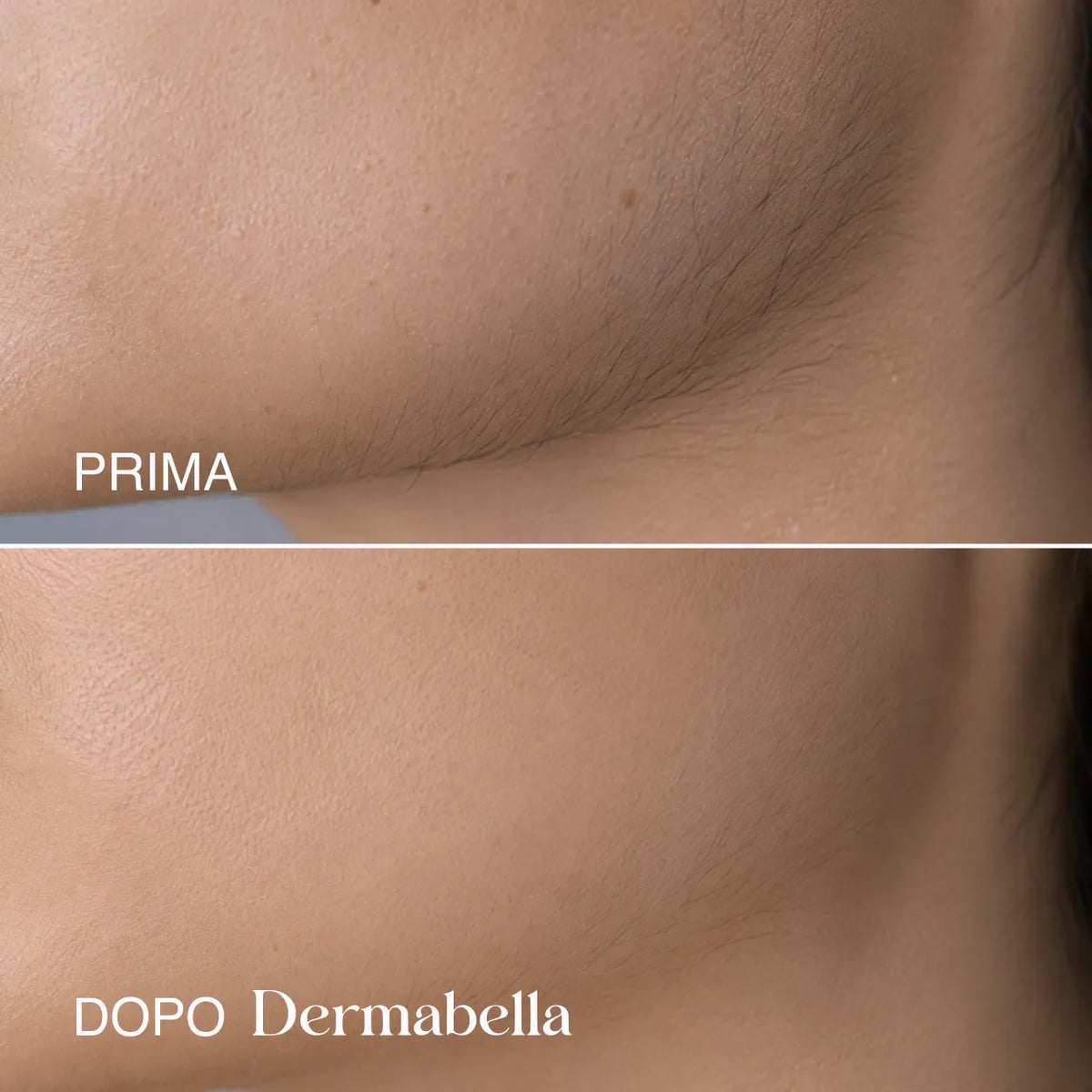 Risultato prima e dopo sulla guancia con Dermabella